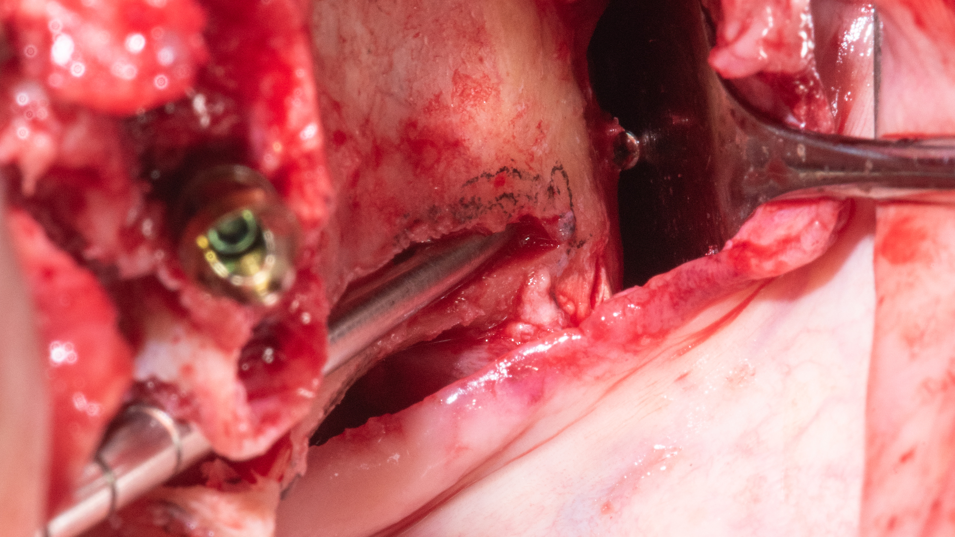 Sinus lift — surgical view