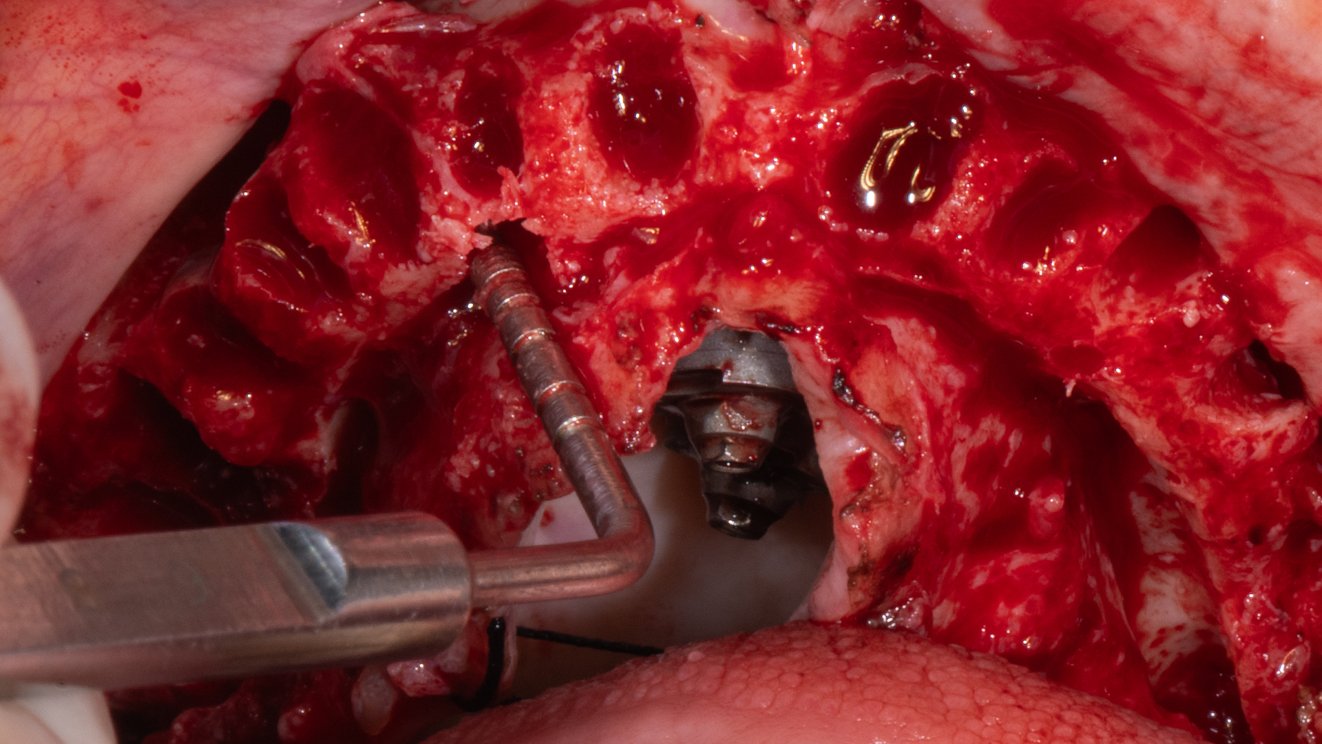 Post-extraction implant