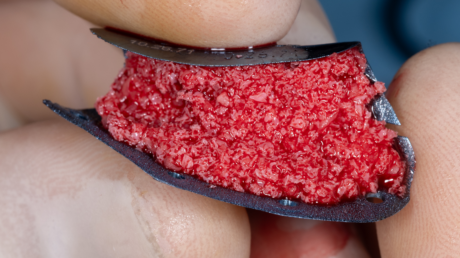 Particulate bone graft