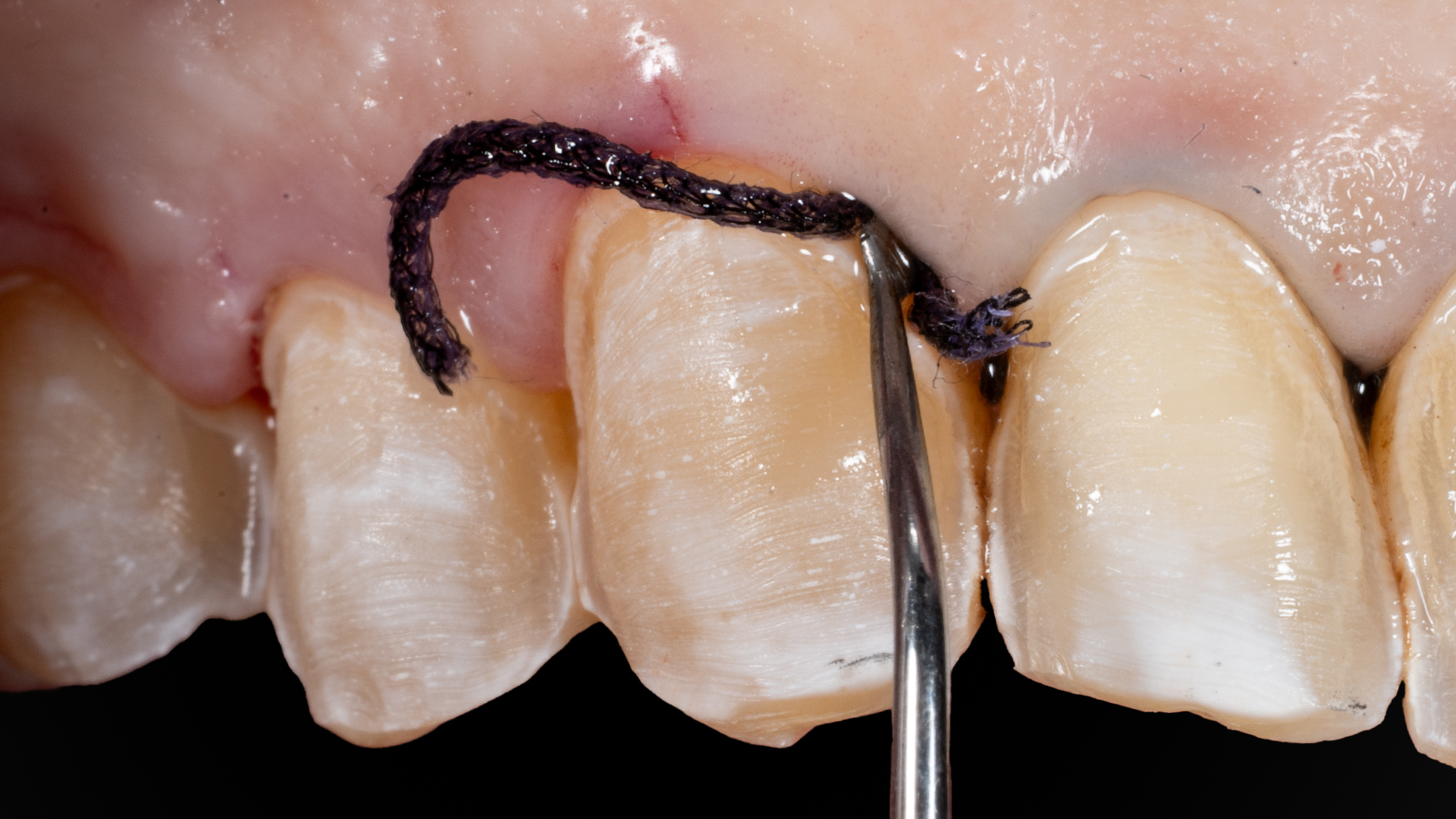Suturing and soft-tissue management