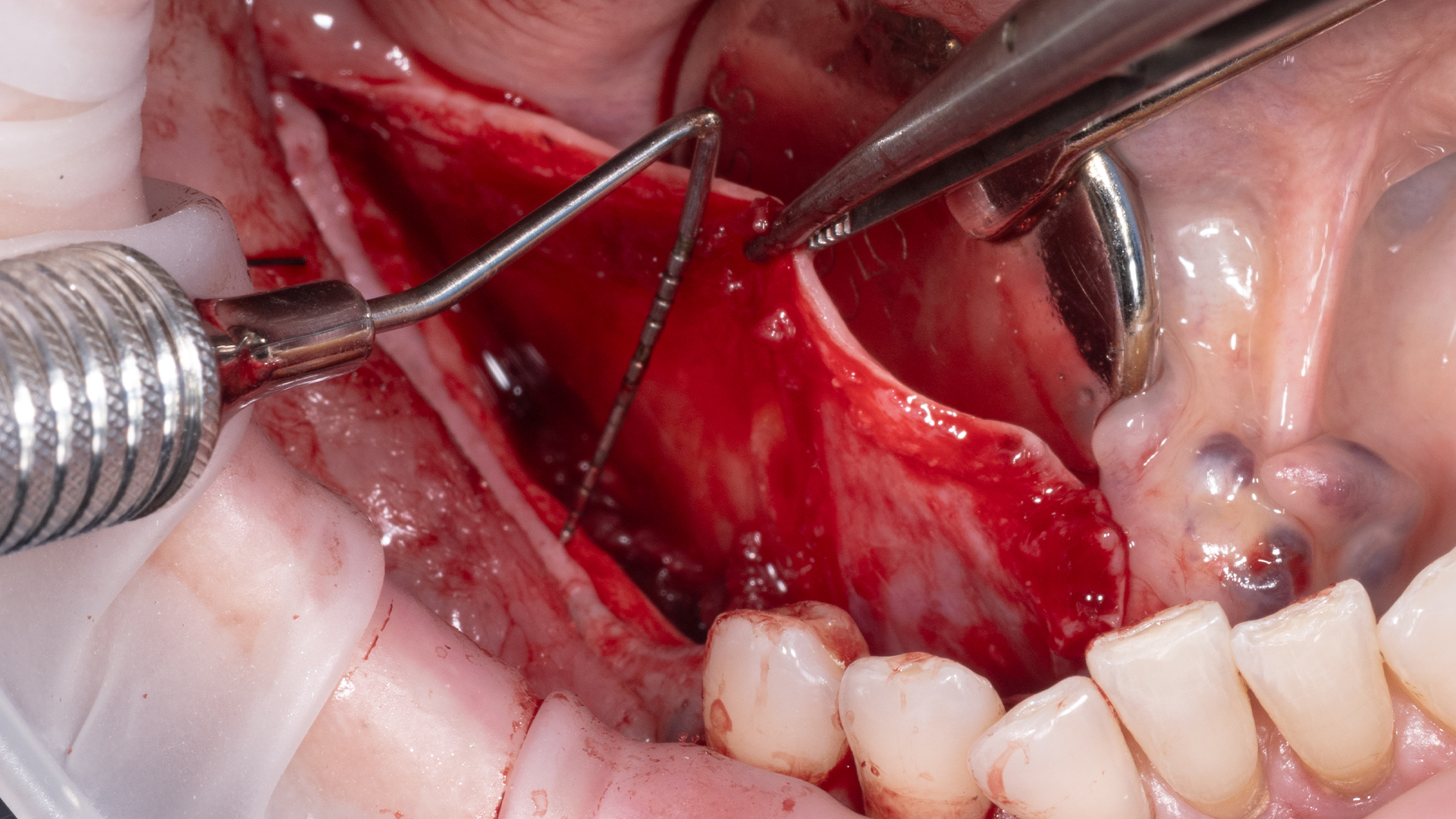 Intraoperative view