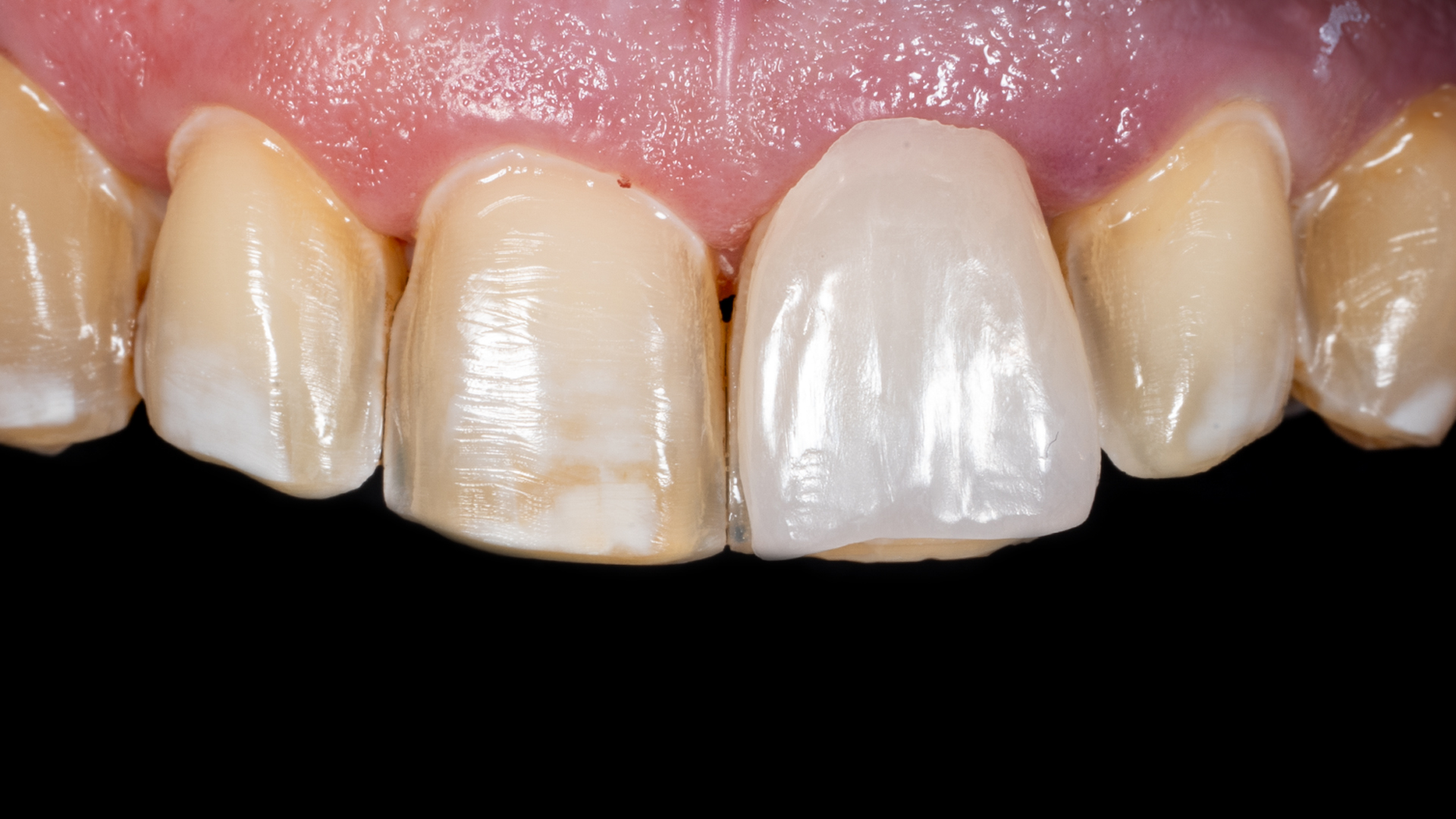 Anterior aesthetic restoration